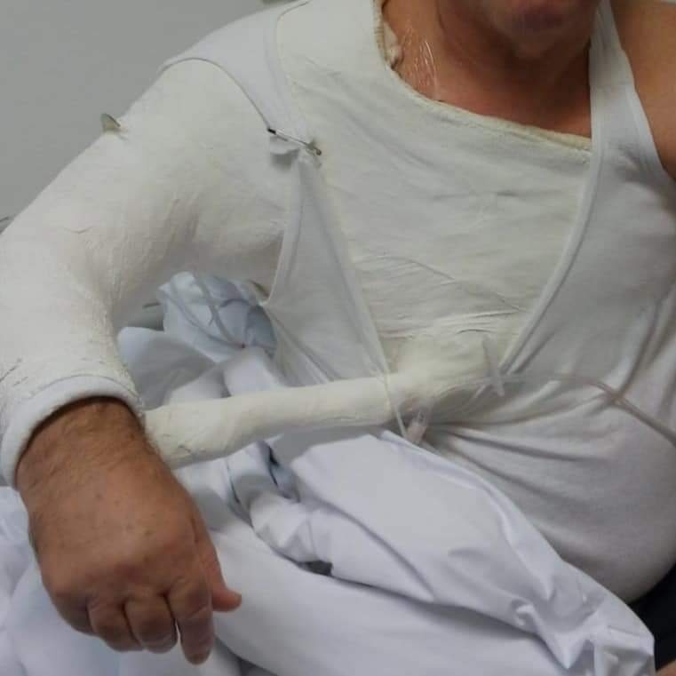 Stara sadrena imobilizacija.