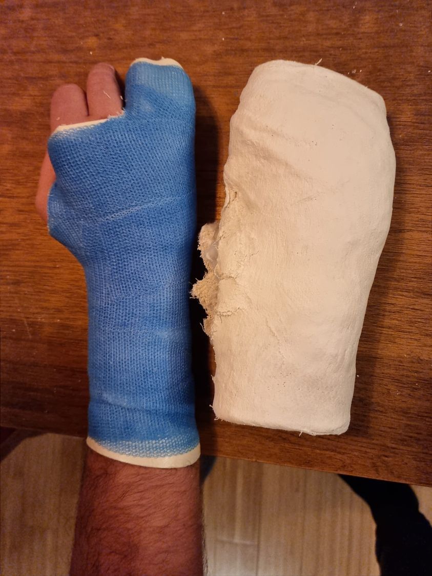 plastični gips prilagođen ruci 