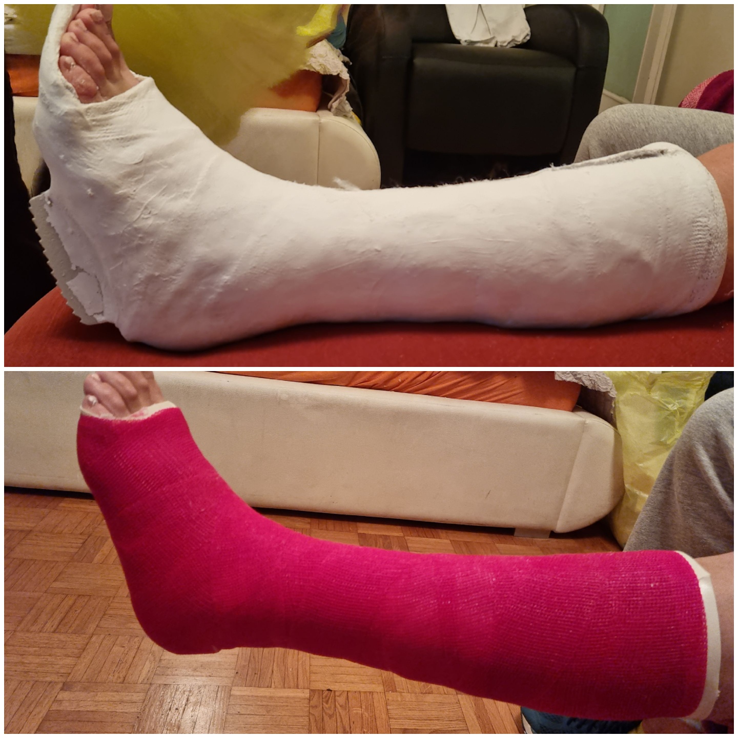 Nadkoljenični gips, puno ugodniji i manji zbog pete ugrađene u gips