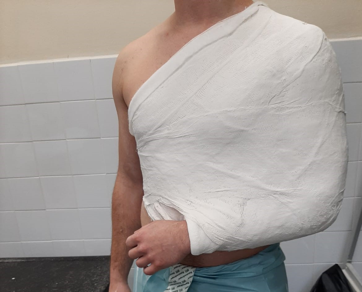 Desault gips ili zvoj